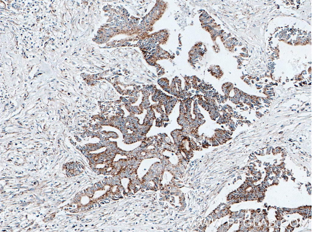 IHC staining of human pancreas cancer using 11082-1-AP