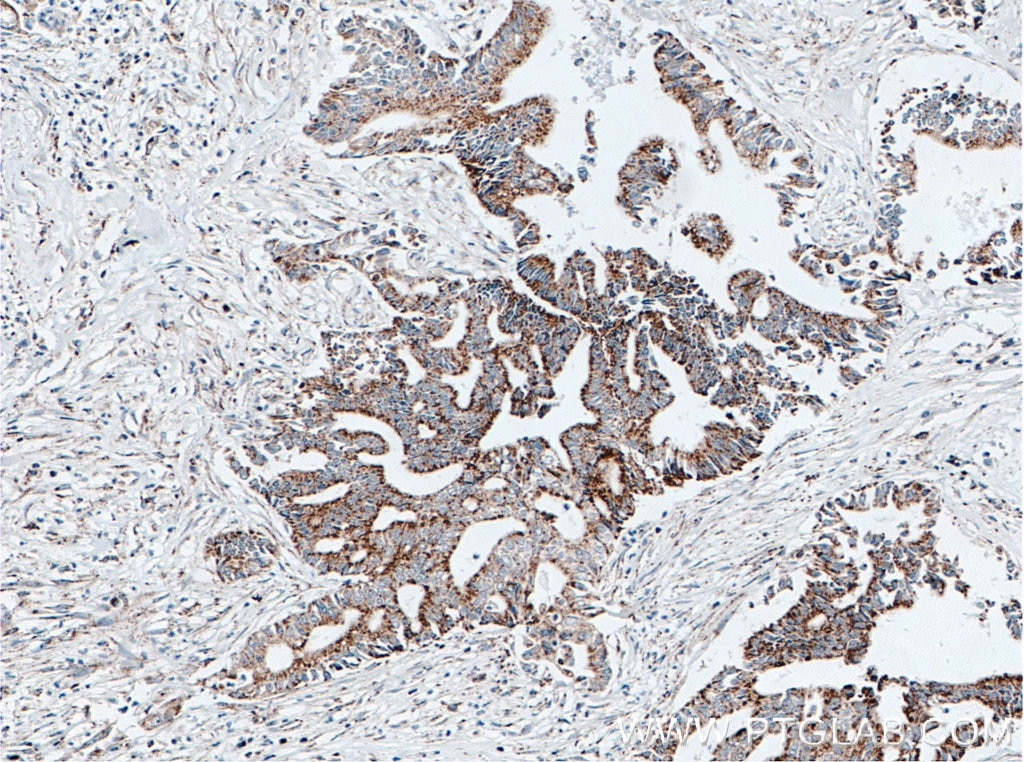 Immunohistochemistry (IHC) staining of human pancreas cancer tissue using PPP1CC Polyclonal antibody (11082-1-AP)