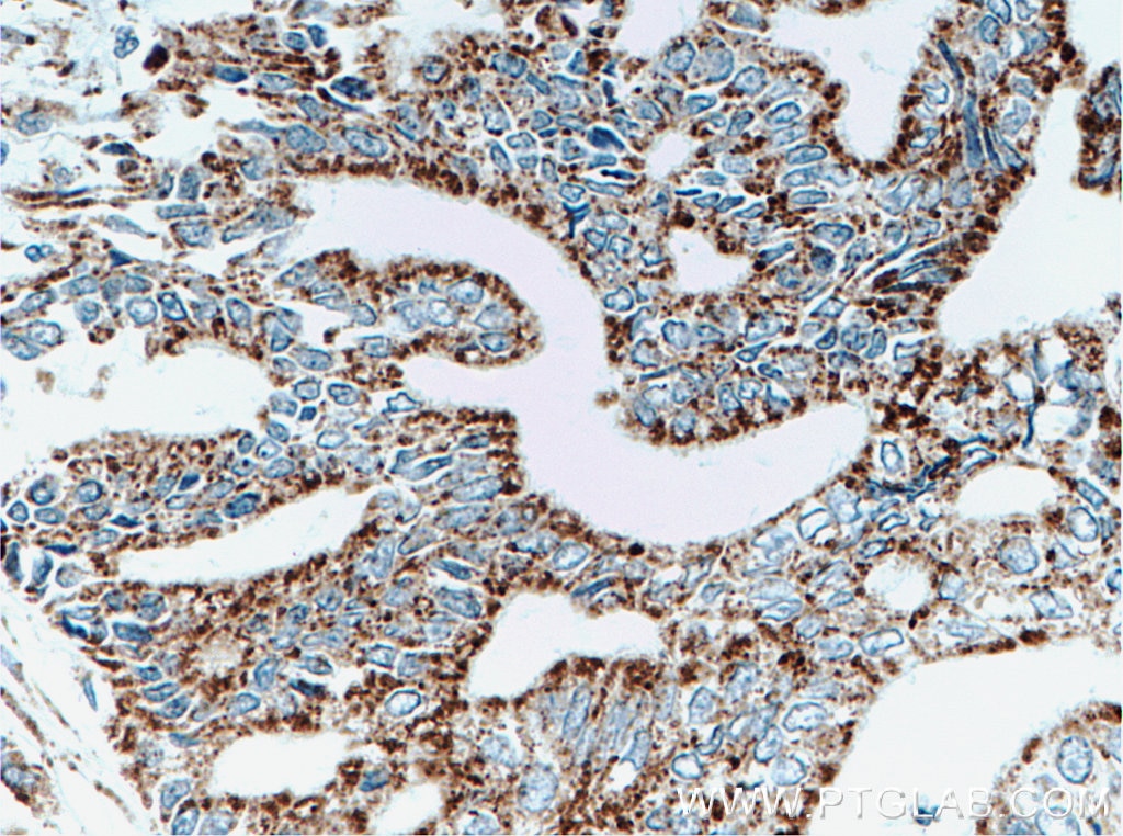 Immunohistochemistry (IHC) staining of human pancreas cancer tissue using PPP1CC Polyclonal antibody (11082-1-AP)