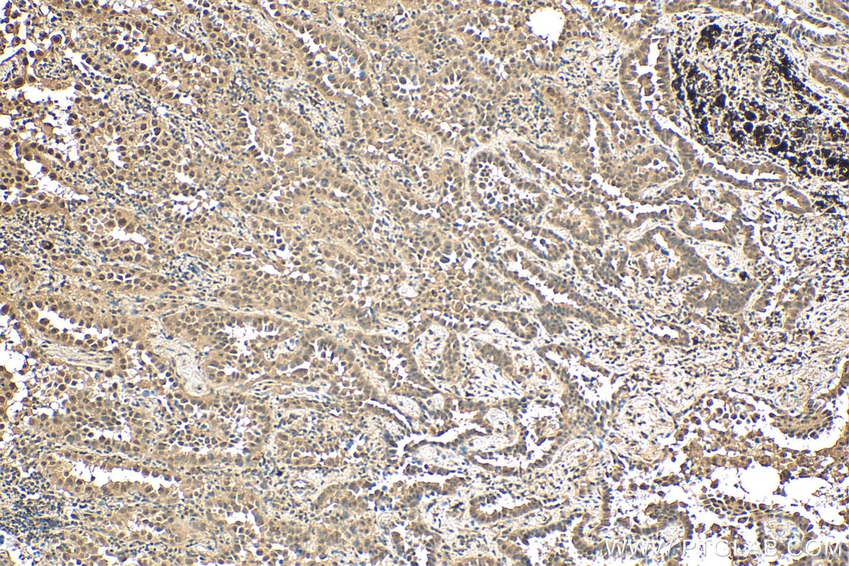 IHC staining of human lung cancer using 29804-1-AP
