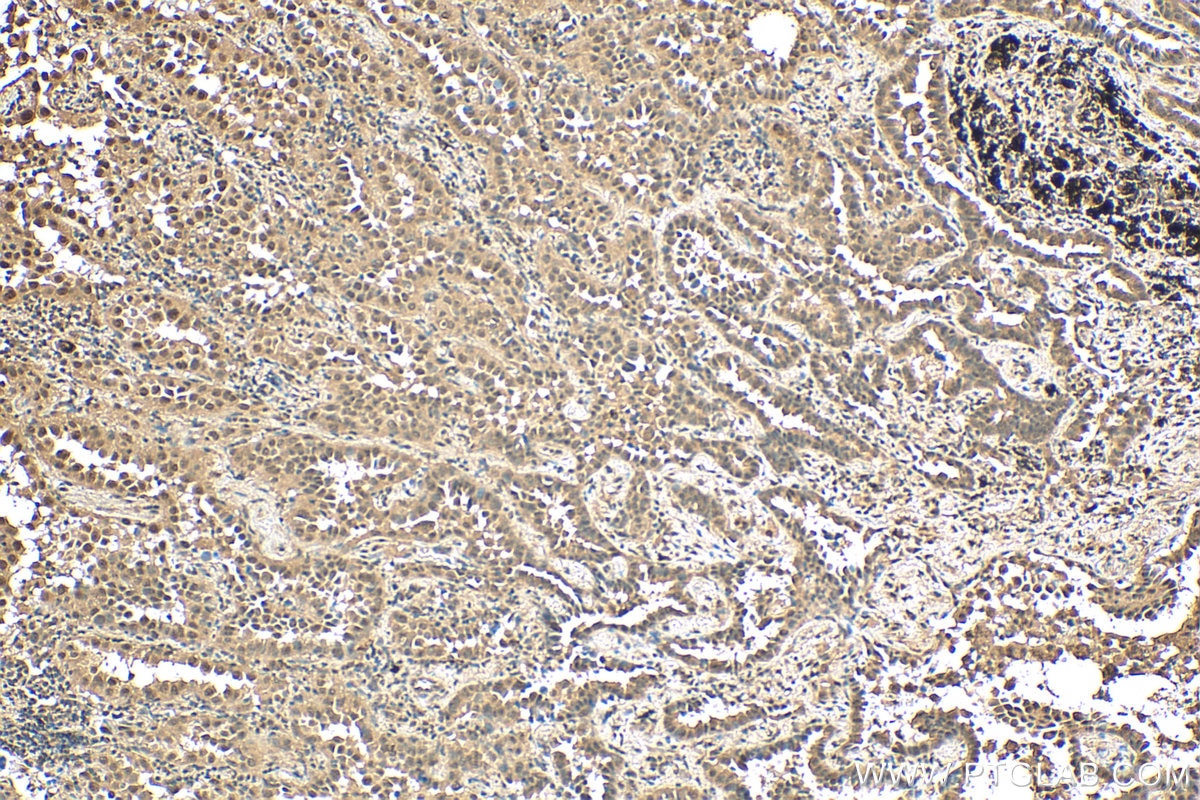 Immunohistochemistry (IHC) staining of human lung cancer tissue using PPP1R13B Polyclonal antibody (29804-1-AP)