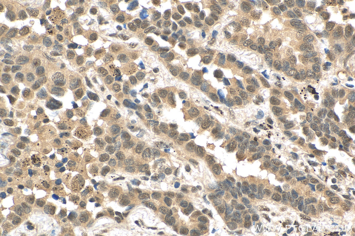 Immunohistochemistry (IHC) staining of human lung cancer tissue using PPP1R13B Polyclonal antibody (29804-1-AP)