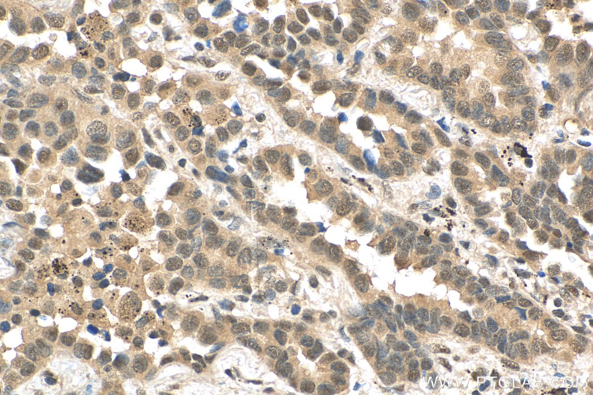 Immunohistochemistry (IHC) staining of human lung cancer tissue using PPP1R13B Polyclonal antibody (29804-1-AP)