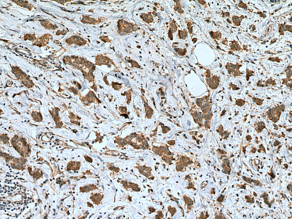 Immunohistochemistry (IHC) staining of human breast cancer tissue using iASPP Polyclonal antibody (18590-1-AP)