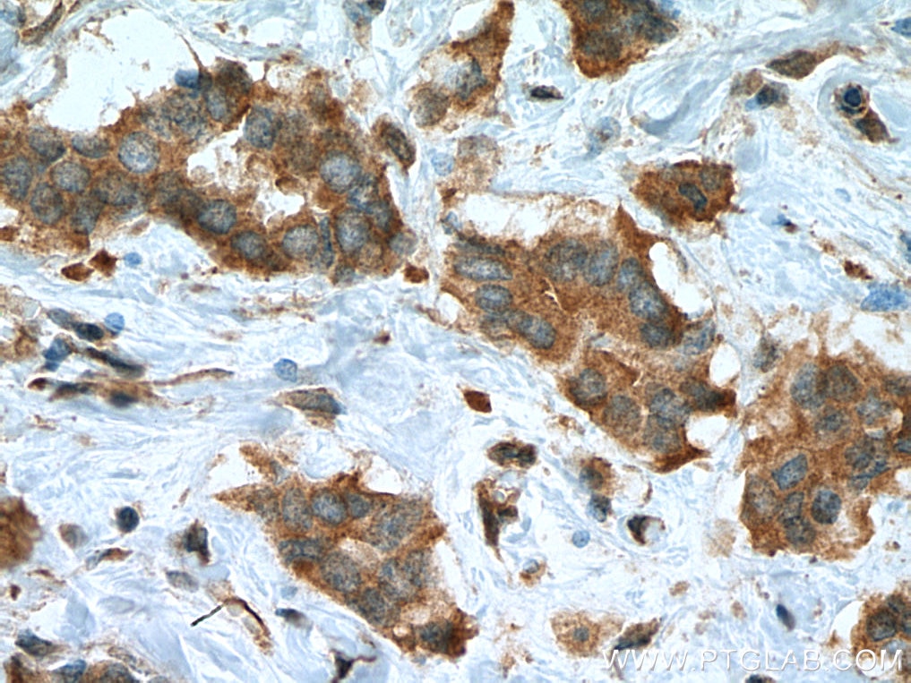 Immunohistochemistry (IHC) staining of human breast cancer tissue using iASPP Polyclonal antibody (18590-1-AP)