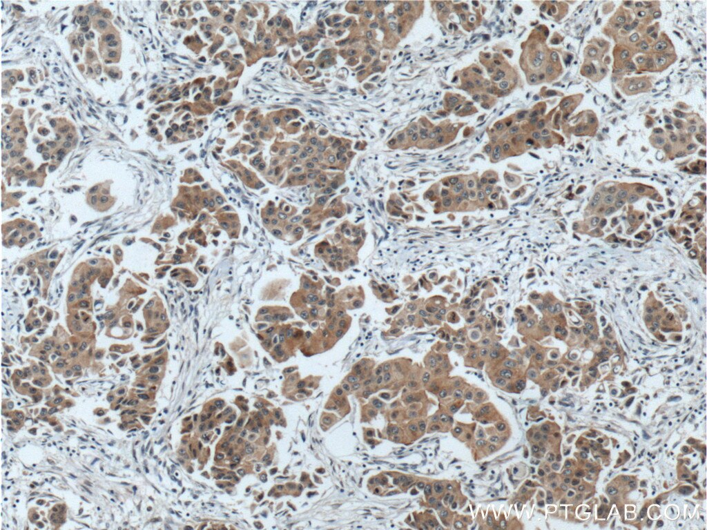 Immunohistochemistry (IHC) staining of human breast cancer tissue using PPP1R13L Polyclonal antibody (51141-1-AP)