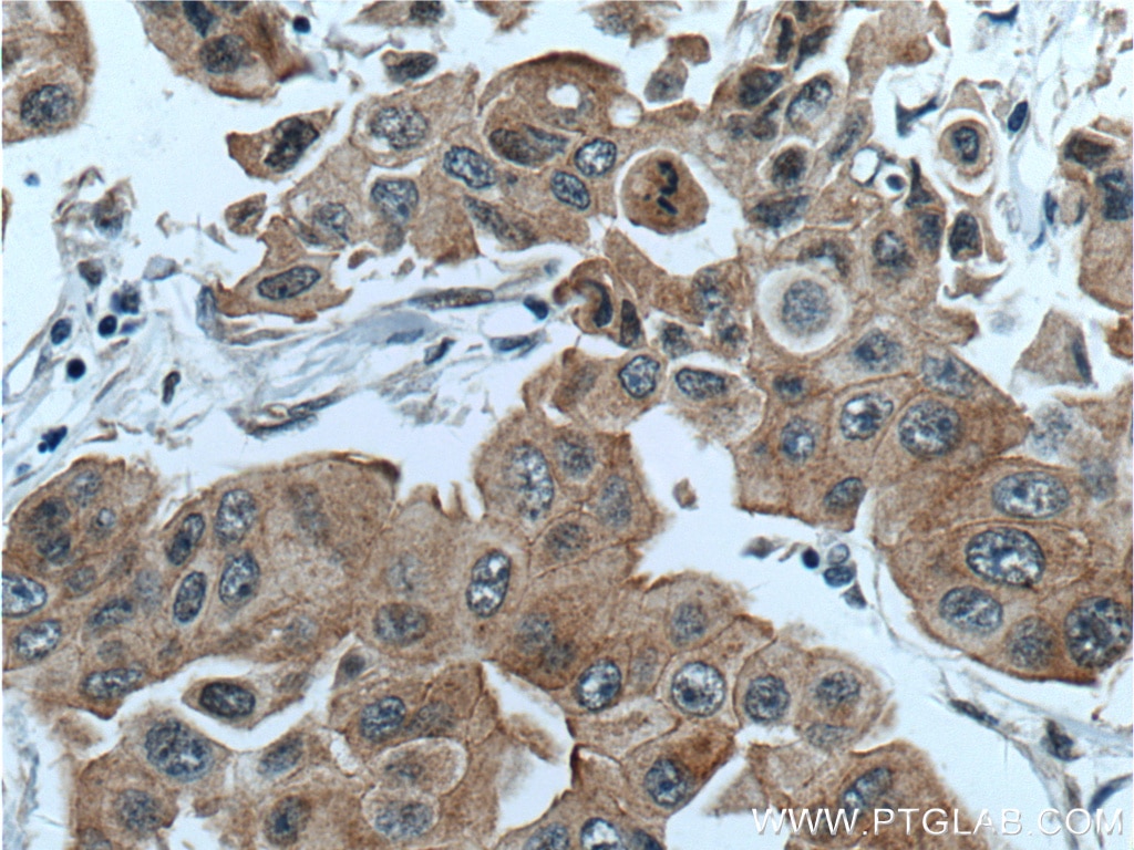 Immunohistochemistry (IHC) staining of human breast cancer tissue using PPP1R13L Polyclonal antibody (51141-1-AP)