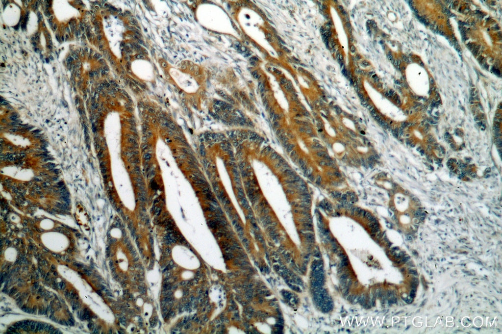 Immunohistochemistry (IHC) staining of human colon cancer tissue using GADD34 Polyclonal antibody (10449-1-AP)