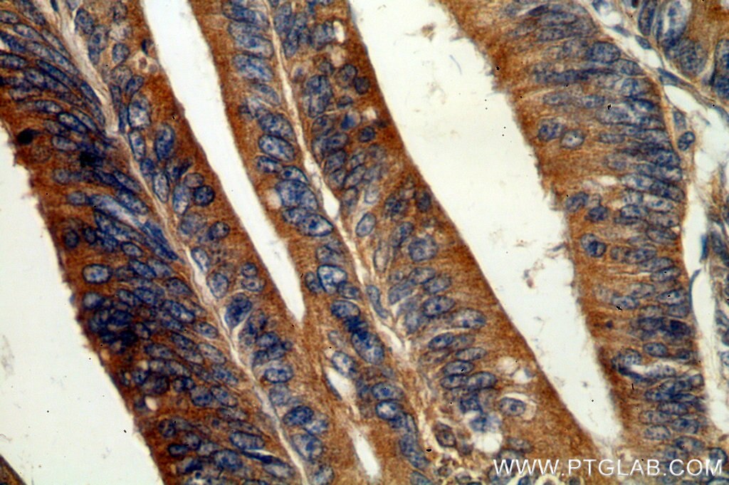 Immunohistochemistry (IHC) staining of human colon cancer tissue using GADD34 Polyclonal antibody (10449-1-AP)