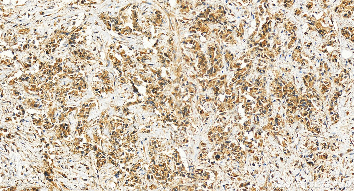 Immunohistochemistry (IHC) staining of human intrahepatic cholangiocarcinoma tissue using PPP1R3B Polyclonal antibody (27285-1-AP)