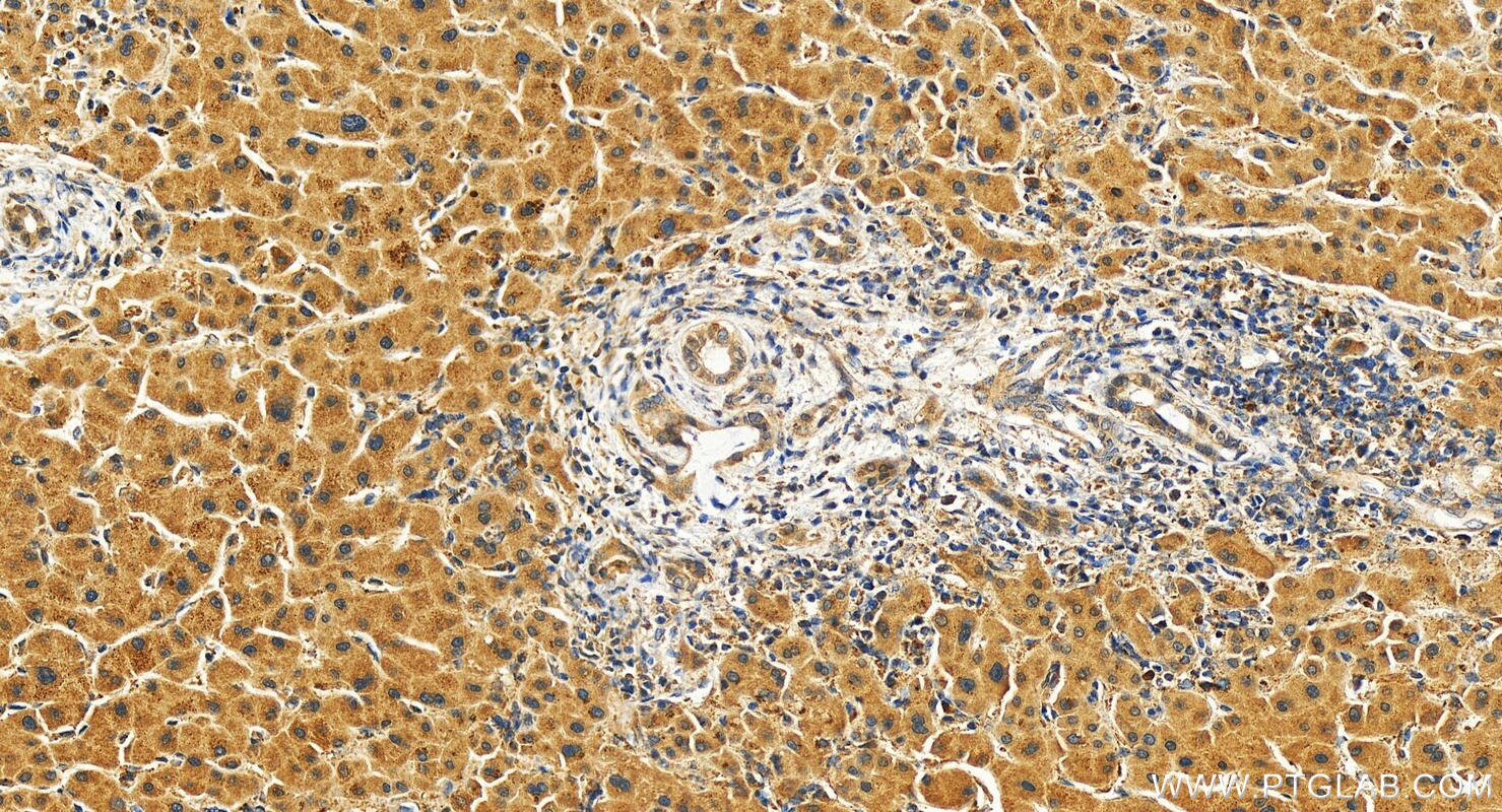 Immunohistochemistry (IHC) staining of human intrahepatic cholangiocarcinoma tissue using PPP1R3B Polyclonal antibody (27285-1-AP)