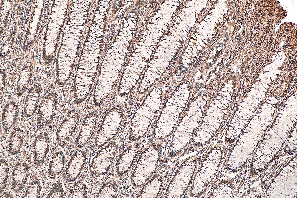 Immunohistochemistry (IHC) staining of human colon cancer tissue using PPP1R3C Polyclonal antibody (29424-1-AP)
