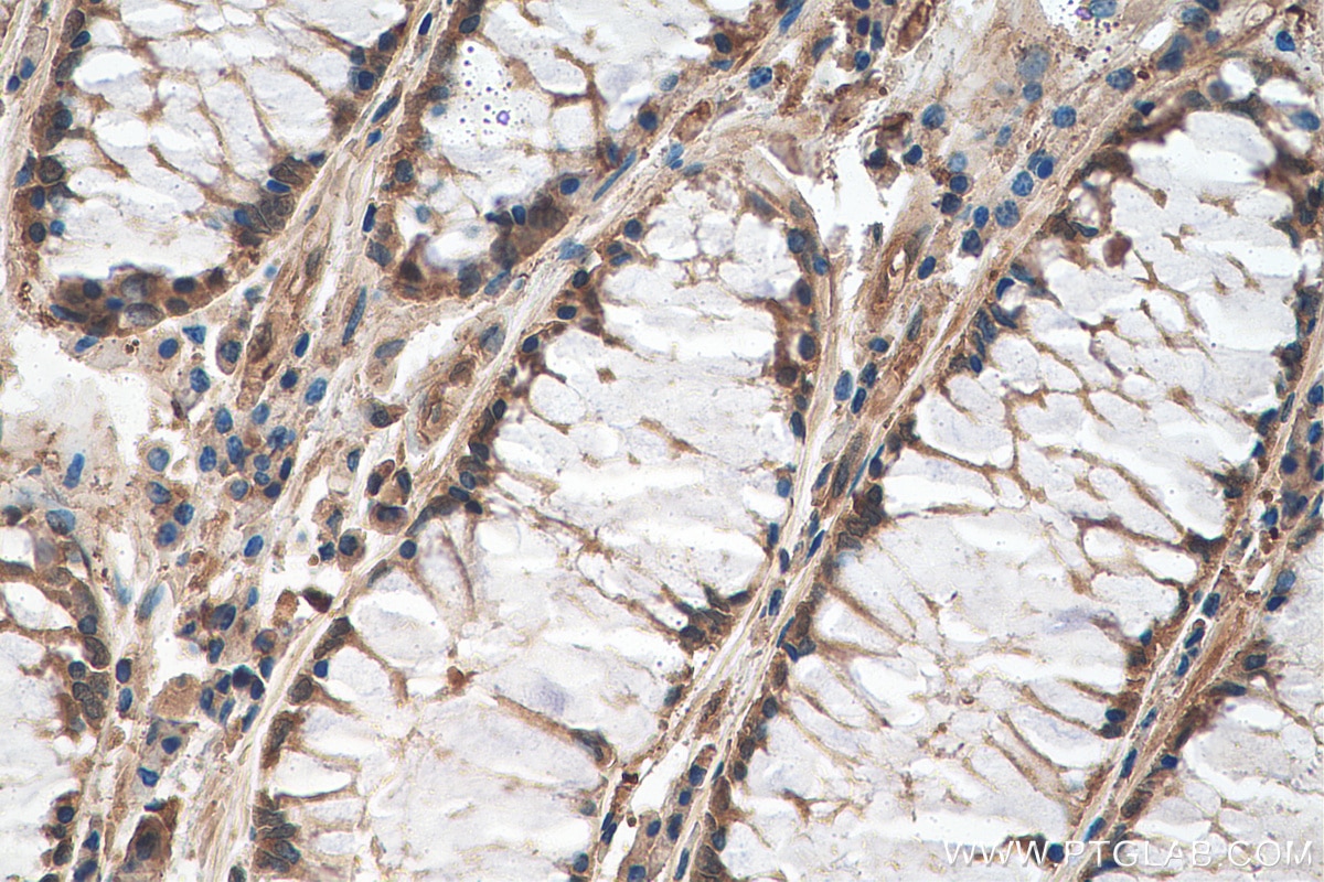 Immunohistochemistry (IHC) staining of human colon cancer tissue using PPP1R3C Polyclonal antibody (29424-1-AP)