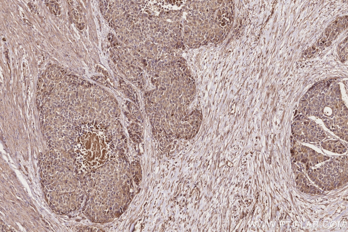 Immunohistochemistry (IHC) staining of human stomach cancer tissue using Neurabin 2 Polyclonal antibody (55129-1-AP)