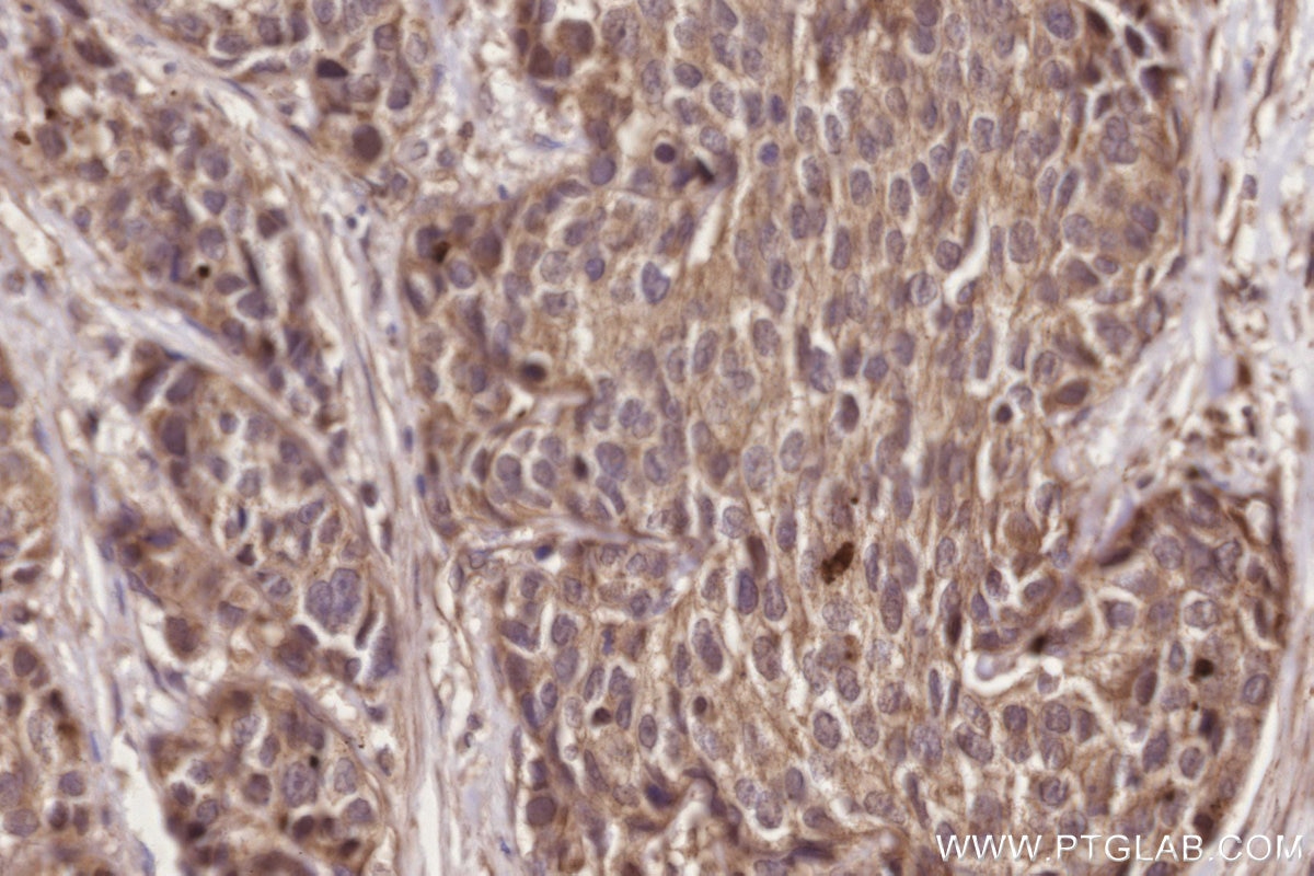 IHC staining of human stomach cancer using 55129-1-AP Immunohistochemistry (IHC) staining of human stomach cancer tissue using Neurabin 2 Polyclonal antibody (55129-1-AP)