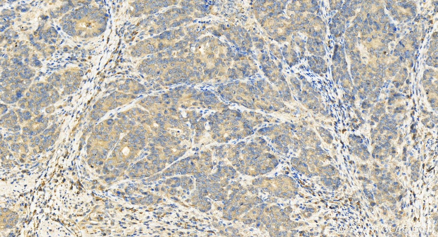 Immunohistochemistry (IHC) staining of human stomach cancer tissue using PPP2CB Polyclonal antibody (12554-2-AP)