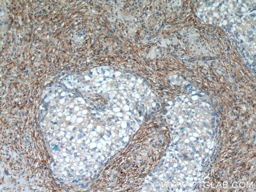 Immunohistochemistry (IHC) staining of human ovary tumor tissue using PPP2R1A Polyclonal antibody (15882-1-AP)