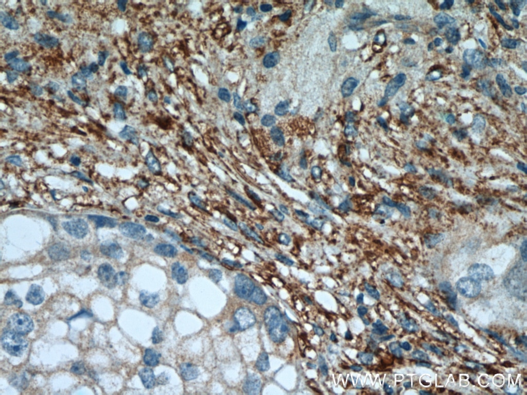 IHC staining of human ovary tumor using 15882-1-AP