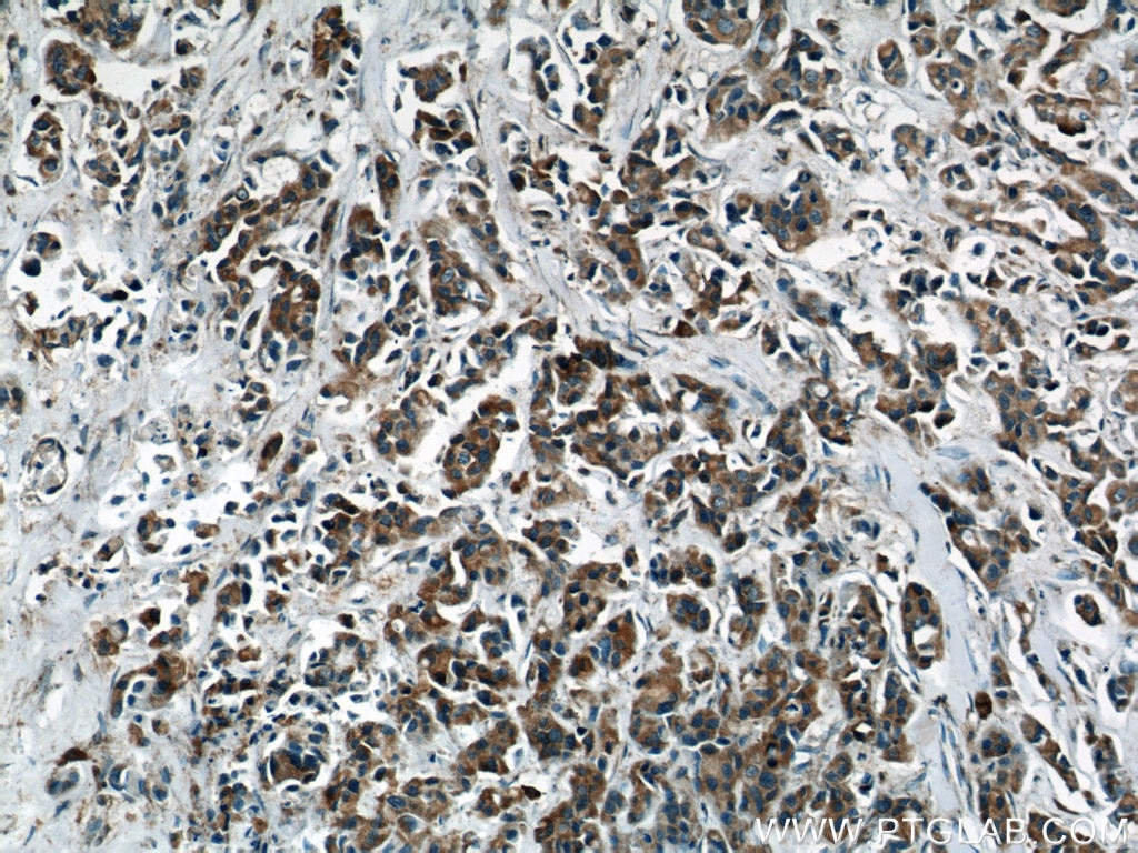 Immunohistochemistry (IHC) staining of human breast cancer tissue using PPP2R2C Polyclonal antibody (12747-1-AP)
