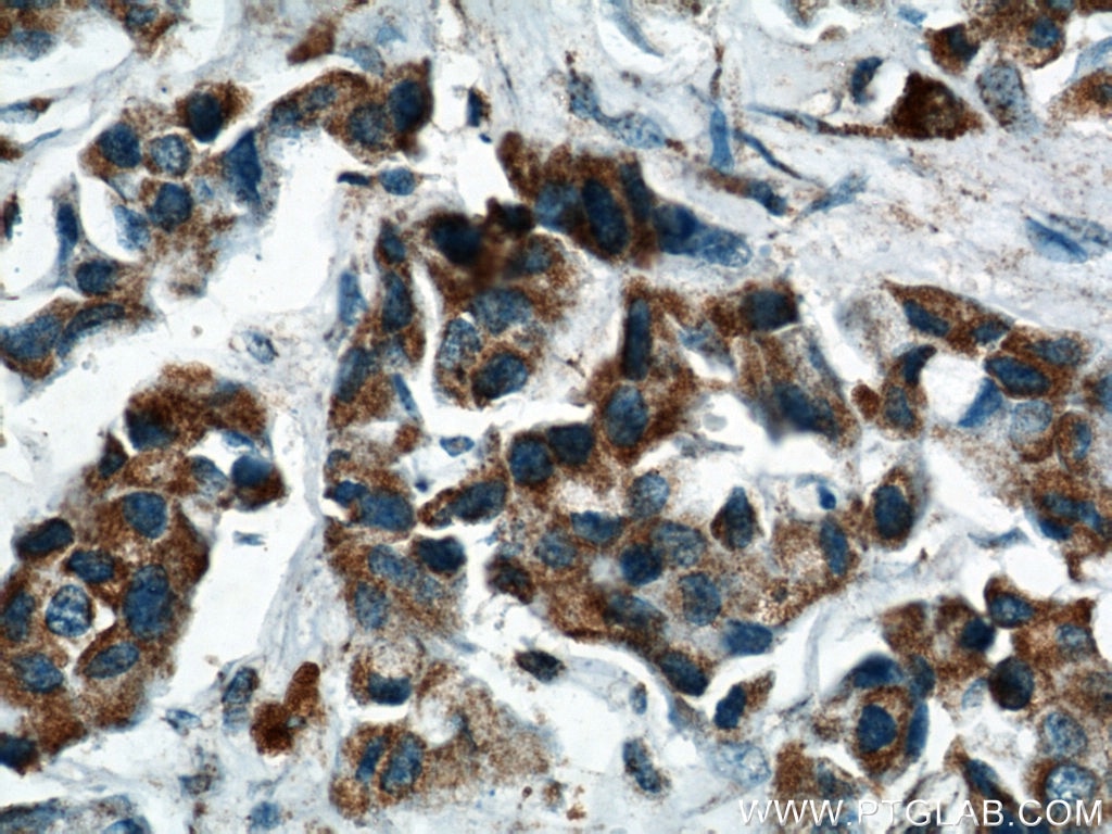 Immunohistochemistry (IHC) staining of human breast cancer tissue using PPP2R2C Polyclonal antibody (12747-1-AP)