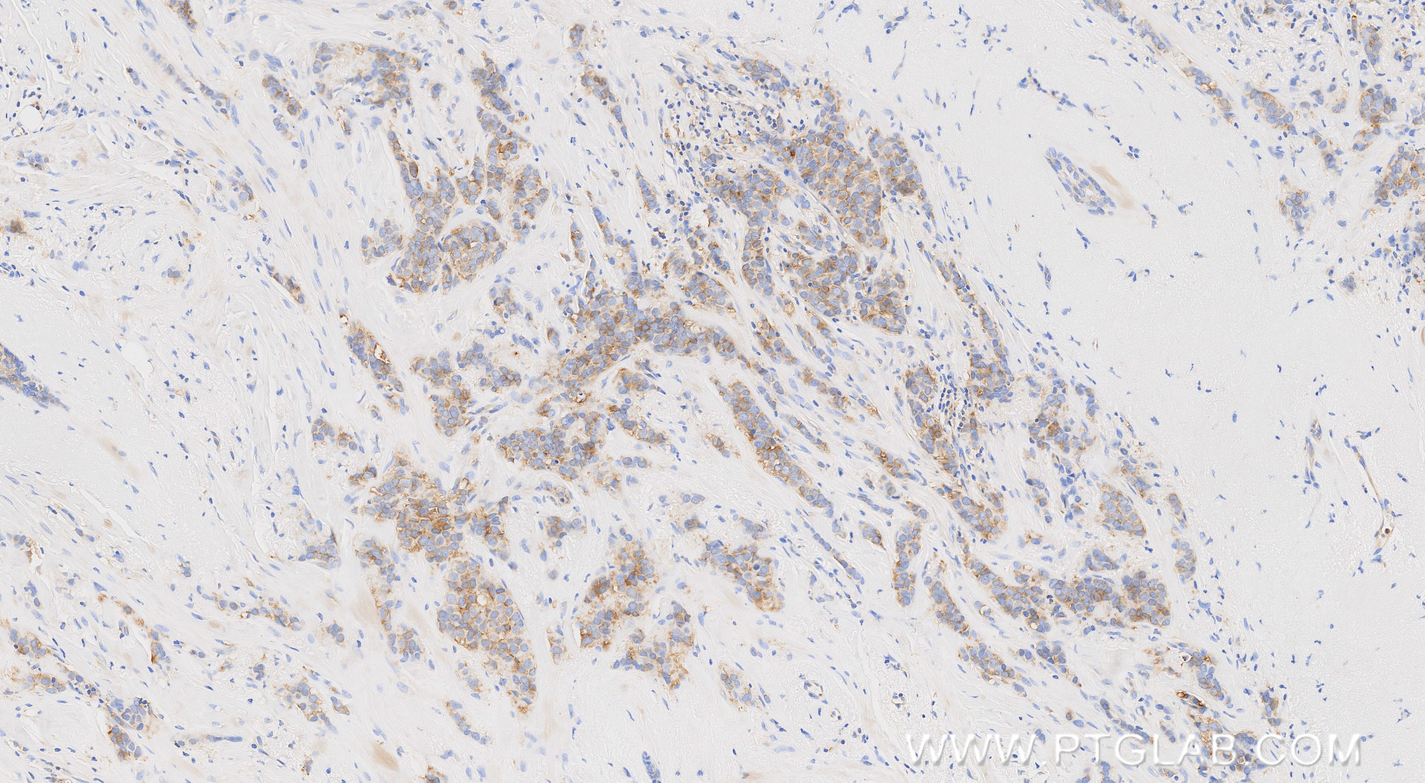Immunohistochemistry (IHC) staining of human breast cancer tissue using PPP2R2C Recombinant monoclonal antibody (86383-1-RR)