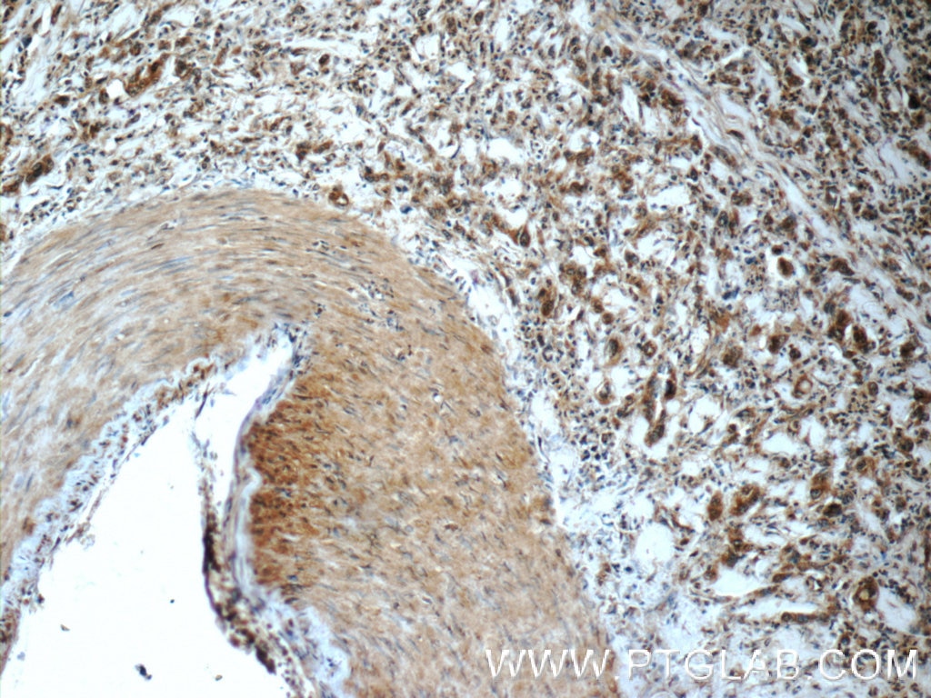 Immunohistochemistry (IHC) staining of human stomach cancer tissue using PPP2R3C Polyclonal antibody (24877-1-AP)