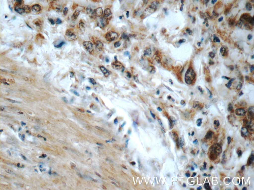 Immunohistochemistry (IHC) staining of human stomach cancer tissue using PPP2R3C Polyclonal antibody (24877-1-AP)