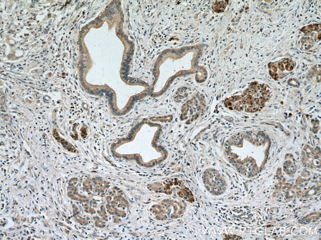 Immunohistochemistry (IHC) staining of human pancreas cancer tissue using PPP2R5A Polyclonal antibody (12675-2-AP)