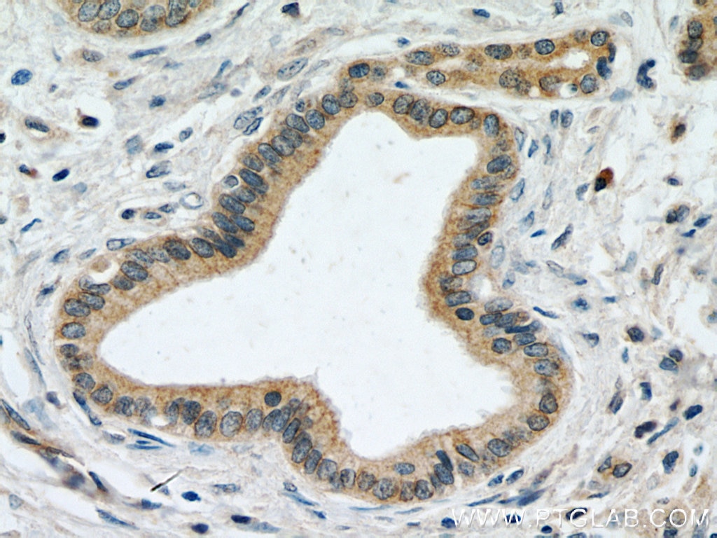 Immunohistochemistry (IHC) staining of human pancreas cancer tissue using PPP2R5A Polyclonal antibody (12675-2-AP)