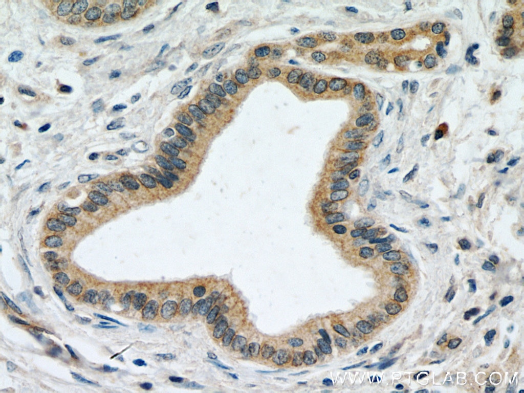 IHC staining of human pancreas cancer using 12675-2-AP