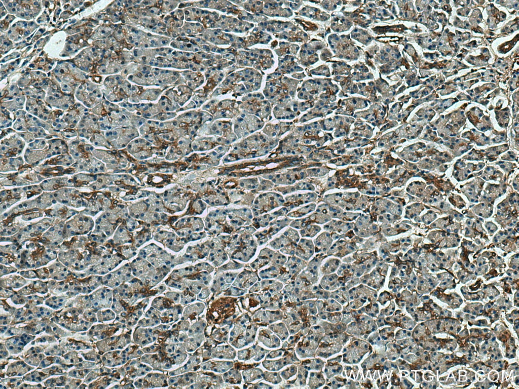 Immunohistochemistry (IHC) staining of human pancreas cancer tissue using PPP2R5A Polyclonal antibody (12675-2-AP)