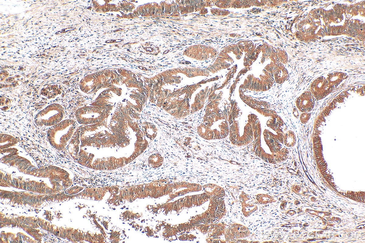 Immunohistochemistry (IHC) staining of human pancreas cancer tissue using PPP2R5A Polyclonal antibody (12675-2-AP)