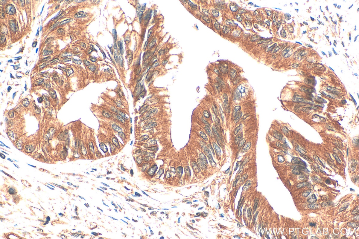 Immunohistochemistry (IHC) staining of human pancreas cancer tissue using PPP2R5A Polyclonal antibody (12675-2-AP)