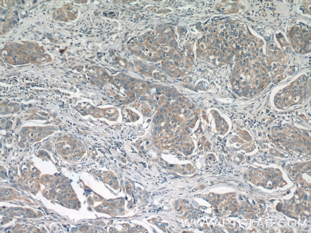 Immunohistochemistry (IHC) staining of human cervical cancer tissue using PPP2R5E Polyclonal antibody (23885-1-AP)