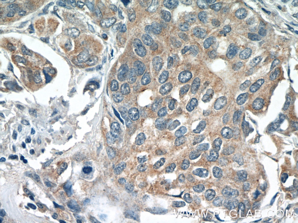 Immunohistochemistry (IHC) staining of human cervical cancer tissue using PPP2R5E Polyclonal antibody (23885-1-AP)