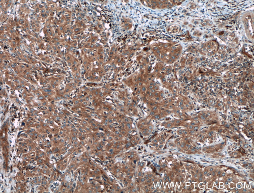 Immunohistochemistry (IHC) staining of human cervical cancer tissue using PPP3CA Polyclonal antibody (13422-1-AP)