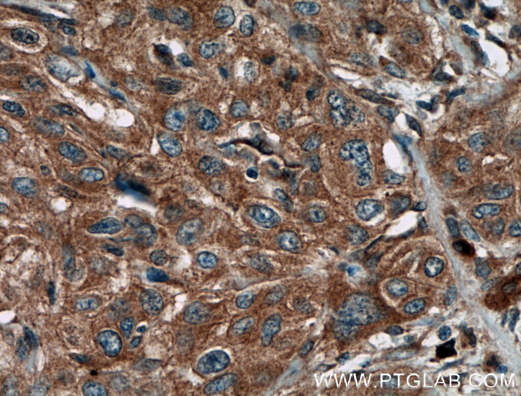 Immunohistochemistry (IHC) staining of human cervical cancer tissue using PPP3CA Polyclonal antibody (13422-1-AP)