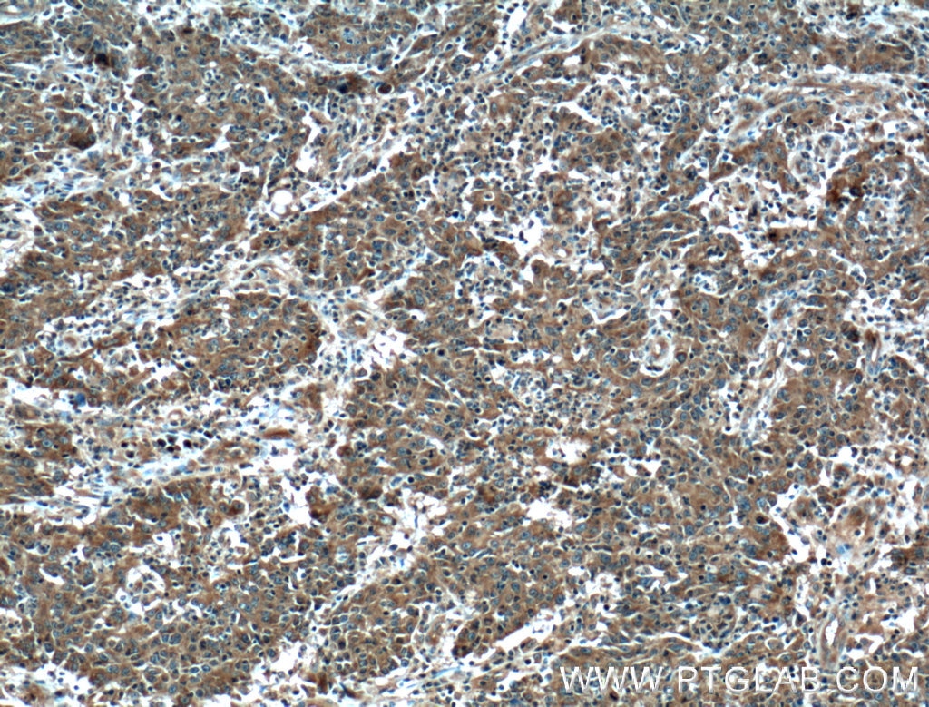 Immunohistochemistry (IHC) staining of human colon cancer tissue using PPP3CA Polyclonal antibody (13422-1-AP)