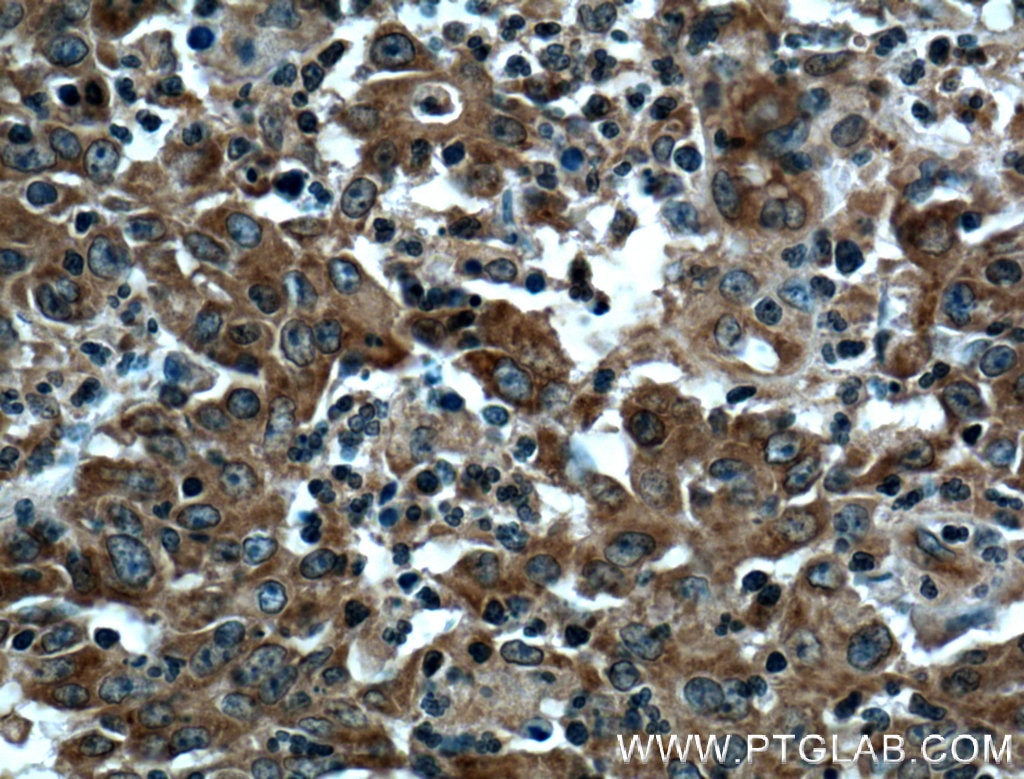 Immunohistochemistry (IHC) staining of human colon cancer tissue using PPP3CA Polyclonal antibody (13422-1-AP)