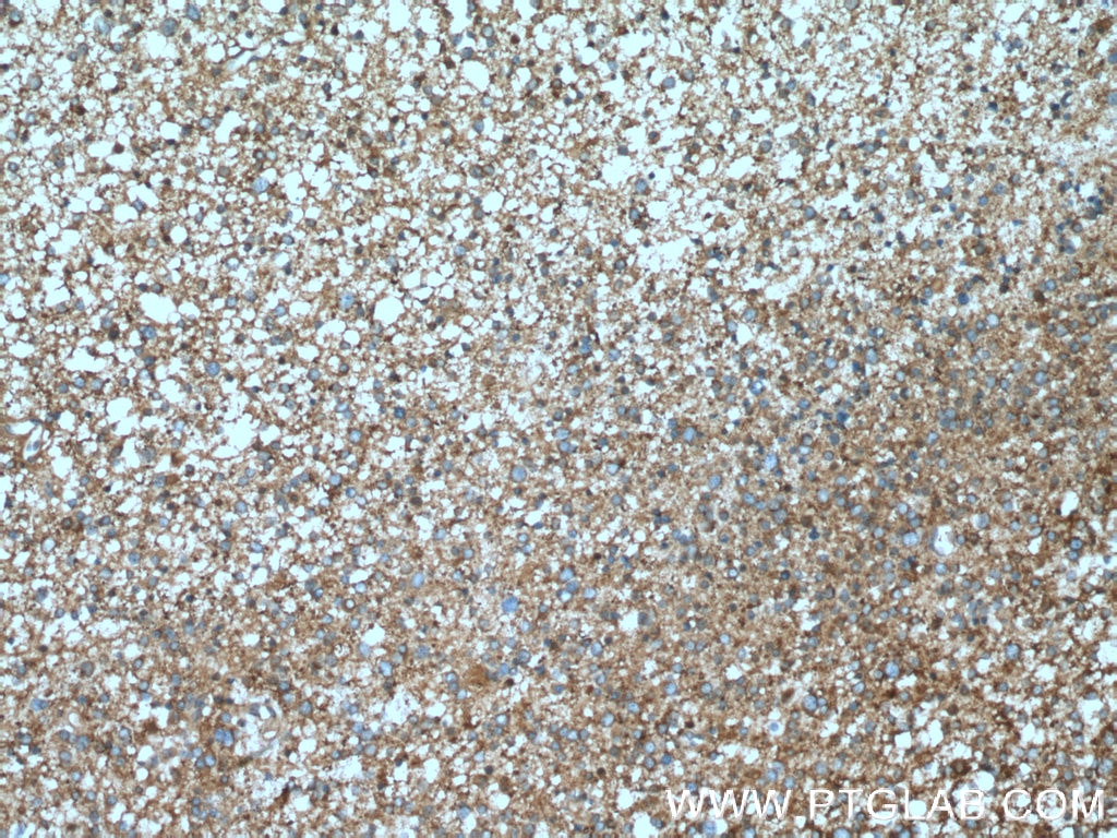 PPP3R1 Antibody IHC human gliomas tissue 13210-1-AP