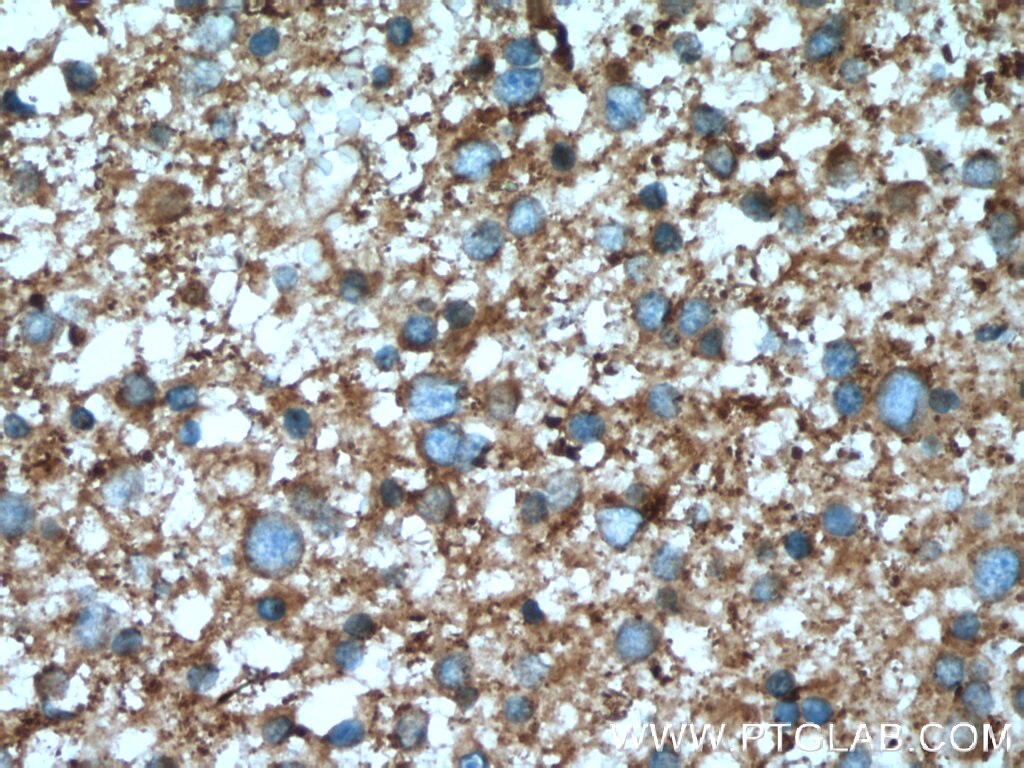 PPP3R1 Antibody IHC human gliomas tissue 13210-1-AP