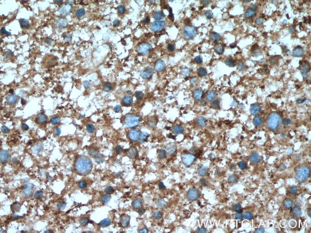 PPP3R1 Antibody IHC human gliomas tissue 13210-1-AP