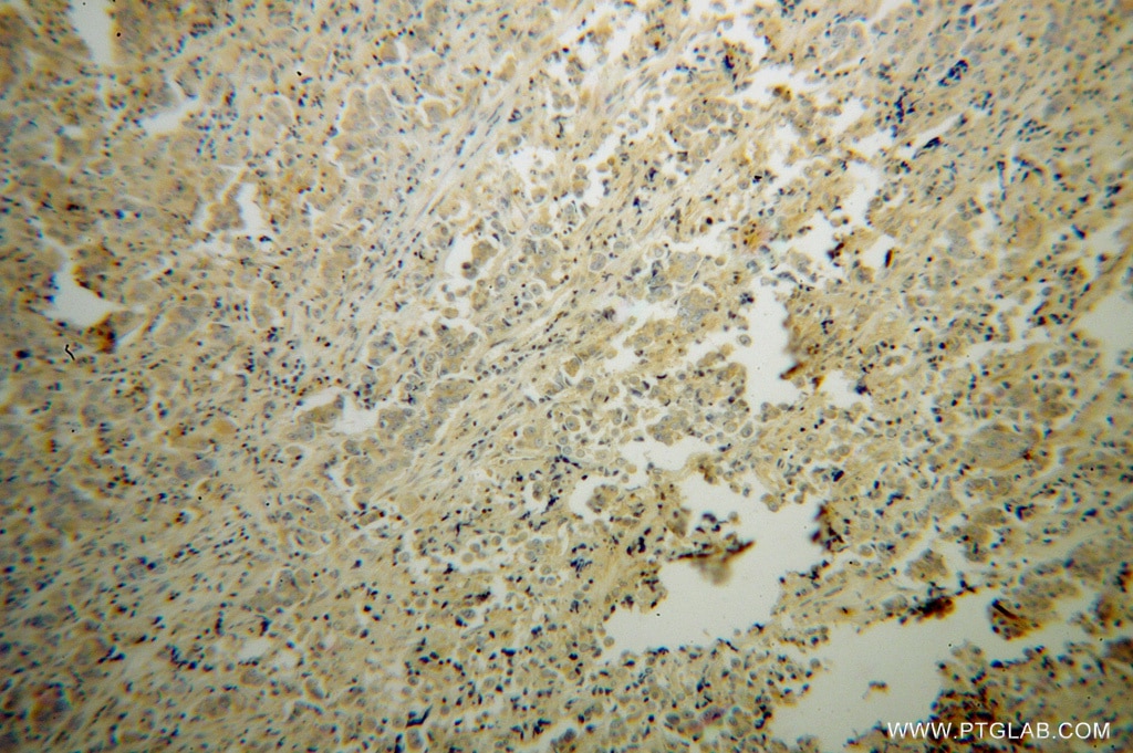 Immunohistochemistry (IHC) staining of human prostate cancer tissue using PPP3R2 Polyclonal antibody (14005-1-AP)