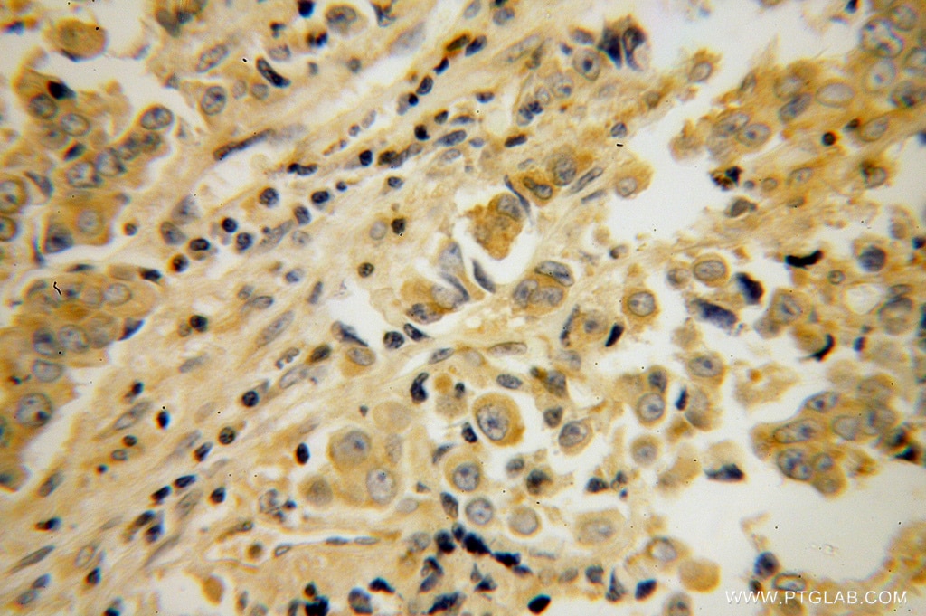 Immunohistochemistry (IHC) staining of human prostate cancer tissue using PPP3R2 Polyclonal antibody (14005-1-AP)