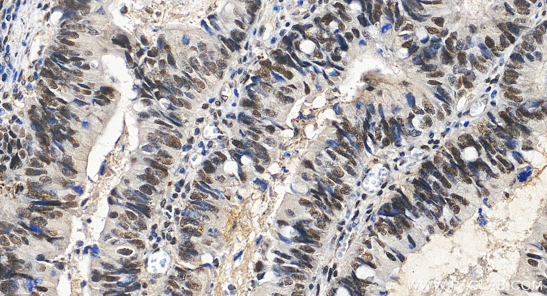 Immunohistochemistry (IHC) staining of human colon cancer tissue using PPP4C Recombinant monoclonal antibody (86600-3-RR)