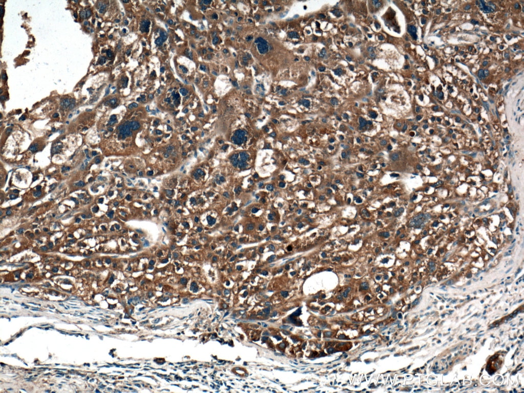 Immunohistochemistry (IHC) staining of human liver cancer tissue using PPP4R1 Polyclonal antibody (27805-1-AP)