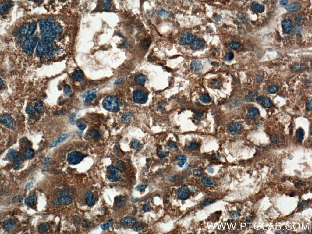 Immunohistochemistry (IHC) staining of human liver cancer tissue using PPP4R1 Polyclonal antibody (27805-1-AP)