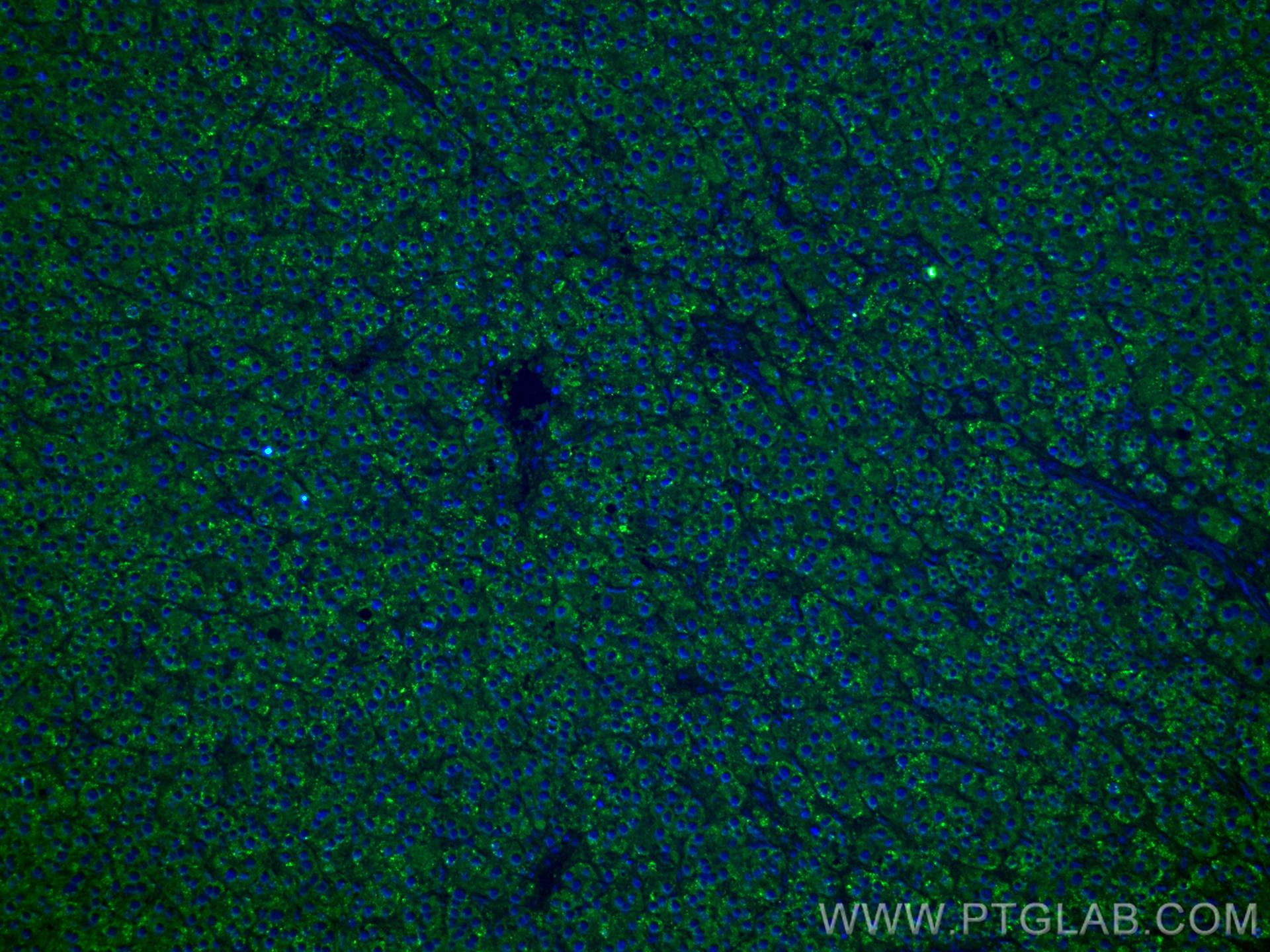 Immunofluorescence (IF) / fluorescent staining of human liver cancer tissue using PPP4R1 Monoclonal antibody (67392-1-Ig)