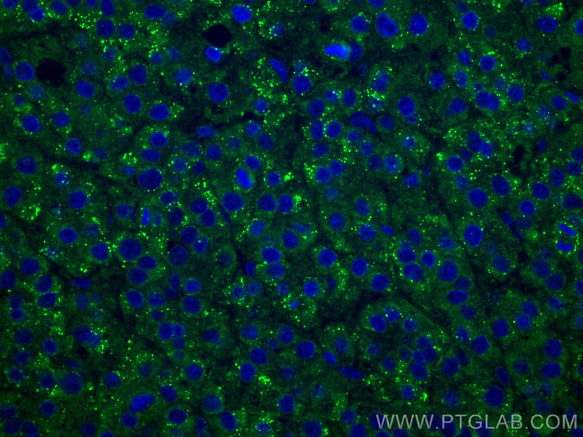 IF Staining of human liver cancer using 67392-1-Ig