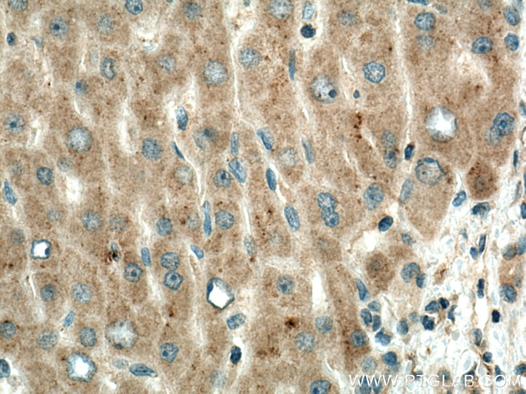 Immunohistochemistry (IHC) staining of human liver cancer tissue using PPP4R1 Monoclonal antibody (67392-1-Ig)